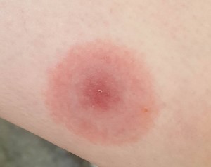 tick rash